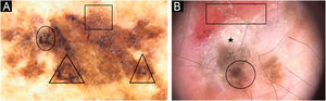 Melanoma in situ. (A) Dermatoscopia mostrando rede atípica (quadrado) e área excêntrica hiperpigmentada (mancha; círculo). (B) Melanoma desmoplásico: ulceração (retângulo), hiperceratose (estrela), estrutura romboidal (círculo) e linhas anguladas (triângulo).