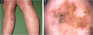 (A) Melanoma na perna direita em paciente do sexo feminino, de 15 anos. (B) Melanoma in situ: dermatoscopia mostrando listras brancas brilhantes (seta) e mancha (estrela).