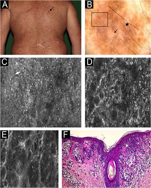Melanoma in situ no dorso de paciente do sexo masculino, 40 anos. (A) Imagem clínica: lesão pigmentada em pele fotodanificada (seta branca). (B) Dermatoscopia: pontos e glóbulos atípicos (quadrado), salpicados (estrela), área sem estrutura (seta). C, Microscopia confocal de reflectância (MCR); imagem individual (0,5×0,5mm) da camada espinosa‐granular. Padrão desarranjado, presença de células nucleadas dendríticas (seta). (D) Imagem individual de MCR (0,5×0,5mm) da área da junção dermoepidérmica (JDE) mostrando padrão anelar (centro). (E) Imagem individual de MCR na JDE (0,5×0,5mm) na derme mostrando malha atípica e papilas sem bordas. (F) Histopatologia: melanócitos atípicos aninhados crescendo ao longo da JDE com disseminação pagetoide, envolvimento de estruturas anexiais e ausência de invasão dérmica. Essas características microscópicas permitem confirmar o diagnóstico de melanoma in situ (Hematoxilina & eosina, 200×).