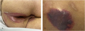 Diagnóstico diferencial de lesão por pressão. (A) Dermatite associada a incontinência em paciente com incontinência urinária e fecal que desenvolveu eritema intenso nas regiões interglútea, perianal e escroto. (B) Úlcera terminal de Kennedy em paciente com falência múltipla de órgãos que desenvolveu rapidamente (em 24 horas) placa purpúrica na região sacral. Fonte: própria dos autores.