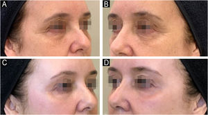 Rejuvenescimento da região periocular com peeling de fenol‐cróton 35%/1,2% em paciente de 58 anos. Ante e após seis meses. A‐C, Hemiface direita. B‐D, Hemiface esquerda.