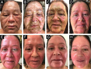 Evolução dia a dia (A‐H), PO 1 a 8, da esquerda para direita na horizontal, do pós‐peeling de fenol‐cróton. Edema, inflamação neutrofílica intensa e eliminação das camadas mais externas da pele, com substituição por uma pele rejuvenescida e viçosa. Em associação com o fenol, o óleo de cróton potencializa a penetração do composto, além de atuar de maneira sinérgica na produção de colágeno e elastina, proporcionando resultados mais efetivos. O eritema no pós‐procedimento pode persistir por até seis meses.