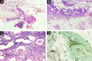 Exame histopatológico da paniculite pancreática. (A) Paniculite aguda supurativa com predomínio lobular (Hematoxilina & eosina, 100×). (B) Infiltrado inflamatório linfocitário e de neutrófilos (Hematoxilina & eosina, 200×). (C) Esteatonecrose com “células‐fantasma” (Hematoxilina & eosina, 400×). (D) Focos de calcificação em meio à esteatonecrose (von Kossa, 400×).