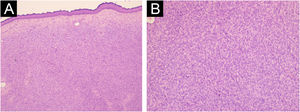 Características histológicas do dermatofibrossarcoma protuberante de padrão clássico: células fusiformes uniformes dispostas em um padrão estoriforme infiltram a derme e se estendem para o tecido subcutâneo (A – Hematoxilina & eosina, 40×; B – Hematoxilina & eosina, 100×).