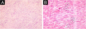 Dermatofibrossarcoma protuberante com transformação fibrossarcomatosa. (A) Células fusiformes dispostas em feixes interseccionais com padrão espinha de peixe (Hematoxilina & eosina, 100×). (B) Numerosas mitoses são observadas (destacadas com círculos; Hematoxilina & eosina, 400×).