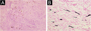 Dermatofibrossarcoma protuberante pigmentado (tumor de Bednar). (A) Numerosas células dendríticas pigmentadas intercaladas entre células fusiformes, demonstrando forte deposição de melanina (Hematoxilina & eosina, 100×). (B) A coloração de Fontana‐Masson destaca a presença de pigmento de melanina dentro de melanócitos dendríticos intercalados entre a proliferação de células fusiformes (Fontana‐Masson, 400×).
