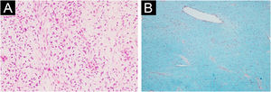 Dermatofibrossarcoma protuberante com alteração mixoide. (A) Proliferação neoplásica de células fusiformes mixoides na derme (Hematoxilina & eosina, 100×). (B) O estroma mixoide proeminente cora‐se difusamente em azul com Alcian blue (coloração com Alcian blue, 100×).