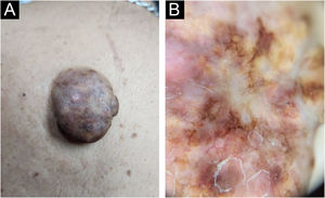Imagens clínicas e dermatoscópicas do Caso 1 [DRD cutânea extranodal]. (A) Lesão cutânea única no dorso medial. (B) Imagem dermatoscópica: áreas branco‐amareladas desorganizadas e manchas de rede pigmentar em fundo vermelho‐leitoso, com vasos telangiectásicos.