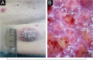 Imagens clínicas e dermatoscópicas do Caso 2 [DRD sistêmico]. (A) Lesão lombar esquerda. (B) Imagem dermatoscópica: áreas amareladas não estruturadas circundadas por regiões vermelho‐leitosas associadas a vasos arborizados em foco, escamas esbranquiçadas e algumas crostas hemorrágicas intracorneanas.