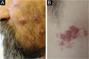 Imagens clínicas do Caso 3 [DRD sistêmico]. (A) Lesões faciais. (B) Lesões axilares.