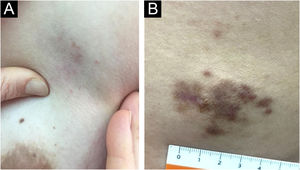 Imagens clínicas dos casos 4 e 5 [DRD cutânea extranodal]. (A) Caso 4. Lesão cutânea única na mama esquerda (nódulo subcutâneo evidente à palpação profunda). (B) Caso 5. Lesão dorsal.
