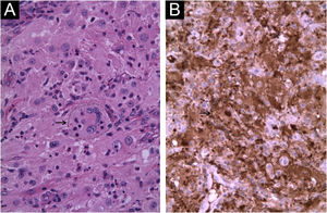 Imagens histopatológicas do caso 2. (A) Hematoxilina & eosina (20×, caso 2). Histiócitos espumosos com citoplasma eosinofílico pálido e emperipolese, acompanhados por linfócitos, neutrófilos, plasmócitos e eosinófilos. (B) Imuno‐histoquímica positiva para S100 em histiócitos (20×, caso 2), especialmente notável no histiócito central da imagem, que mostra o fenômeno de emperipolese. A emperipolese é indicada pela seta e pela linha tracejada em ambas as figuras.