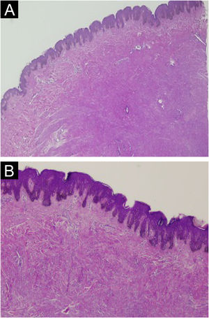 Caso 1. (A) Proliferação dérmica circunscrita de células musculares lisas monótonas (Hematoxilina & eosina, 20×). (B) Feixes entrelaçados de células musculares lisas com escasso tecido conjuntivo interveniente (Hematoxilina & eosina, 40×).