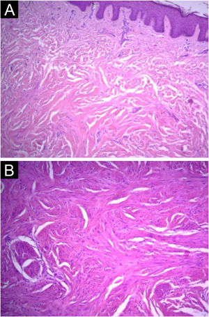 Caso 2. (A) Proliferação de células musculares lisas esboçando feixes interseccionados (Hematoxilina & eosina, 100×). (B) Células com núcleos alongados, citoplasma eosinofílico, sem atipias significantes ou figuras de mitose (Hematoxilina & eosina, 100×).