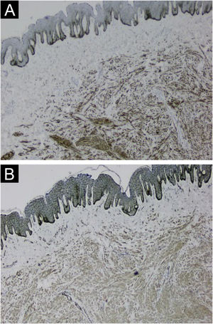 Caso 1. (A) Imuno‐histoquímica com anticorpo desmina mostrando positividade nas células neoplásicas (40×). (B) Imuno‐histoquímica com anticorpo actina de músculo liso mostrando positividade nas células neoplásicas (40×).