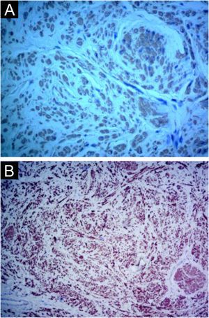 Caso 2. (A) Imuno‐histoquímica com anticorpo actina de músculo liso, mostrando positividade nas células neoplásicas (400×). (B) Imuno‐histoquímica com anticorpo desmina, mostrando positividade nas células neoplásicas (400×).