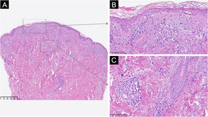Características morfológicas consistentes com o diagnóstico clínico do subtipo subagudo de lúpus eritematoso cutâneo. A biopsia de pele (coloração com Hematoxilina & eosina) mostrou adelgaçamento epidérmico (A, 40×), áreas de dermatite de interface com vacuolização da camada basal (B, 100×), mucina dérmica, incontinência pigmentar e infiltrado linfocitário perivascular (C, 100×).