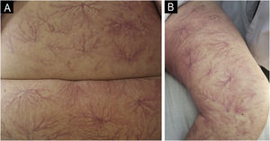 Imagens clínicas. Múltiplas telangiectasias do tipo dendríticas generalizadas no abdome (A) e na coxa (B).