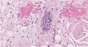População linfoide intravascular atípica com células monomórficas, uniformemente aumentadas e com nucléolos proeminentes (Hematoxilina & eosina, 400×).