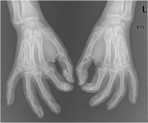 Radiografia simples das mãos (incidência oblíqua) antes do tratamento com tiossulfato de sódio intralesional.
