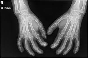 Radiografia simples das mãos (incidência oblíqua) após 25 sessões de tratamento com tiossulfato de sódio intralesional.