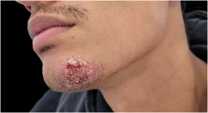 Exame físico revelando nódulo eritematoso de 3×3cm no mento, com ulceração central coberta por exsudato amarelado e crosta.