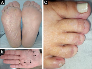 (A) Hiperqueratose difusa na planta direita. (B) Hiperqueratose focal na palma direita (setas). (C) Microníquia do segundo ao quarto pododáctilos direitos.