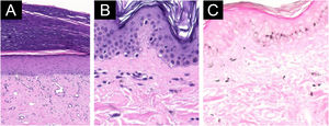 Microscopia óptica com achados inespecíficos. (A) Lesão hiperqueratótica da palma direita com importante retificação da epiderme com orto-hiperqueratose e na derme observam‐se fibrose e proliferação de pequenos vasos (Hematoxilina & eosina, 200×). (B) Hiperpigmentação no abdome com focos de degeneração vacuolar de células basais com leve derrame pigmentar (Hematoxilina & eosina, 400×). (C) Coloração de Fontana‐Masson demonstrando distribuição irregular de melanina na epiderme e derrame pigmentar (×200).