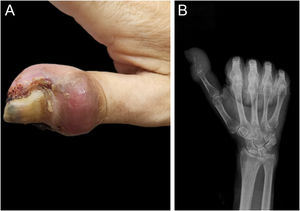(A) A falange distal do polegar direito apresentava edema vermelho‐arroxeado circundando o dedo, acompanhado por erosões das pregas ungueais, espessamento da lâmina ungueal, descoloração e irregularidades morfológicas. (B) A imagem radiográfica revelou extensa destruição óssea e perda da integridade anatômica da falange distal.