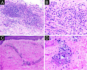 Achados histopatológicos. Biopsia de lesão no tronco evidencia infiltrado mono e polimorfonuclear, com neutrófilos particulados e hemácias extravasadas, sem sinais de vasculite (A, Hematoxilina & eosina, 200×; B, Hematoxilina & eosina, 400×). Biopsia de lesão em membro inferior demonstra hemácias extravasadas, infiltrado inflamatório misto perivascular com leucocitoclasia e presença de trombos de fibrina na parede dos capilares (C, Hematoxilina & eosina, 100×; D, Hematoxilina & eosina, 400×).
