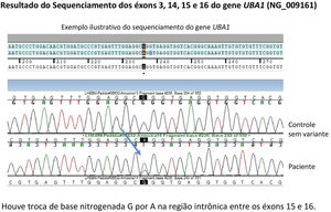 Teste genético do gene UBA1 com sequenciamento do DNA pelo método de Sanger dos éxons 3, 14, 15 e 16. Identificada mutação entre os éxons 15 e 16, com troca da base nitrogenada G por A.
