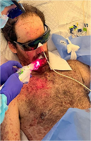 Aplicação de terapia a laser de baixa intensidade. Com o aparelho Duo Laser (InGaAIP, MMOptics), foram realizadas sessões diárias, com comprimentos de onda de 660nm e 808nm, e fluência de 6J/cm2 por ponto de aplicação, abrangendo lábios, mucosa jugal, palato duro e língua.