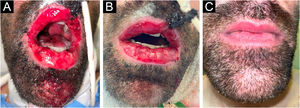 (A–C) Resposta clínica da mucosa oral. (A) 48 horas do início da terapia a laser de baixa intensidade (LLLT). (B) 72 horas do início da LLLT. (C) Uma semana após a alta hospitalar (23 dias da primeira sessão de LLLT).