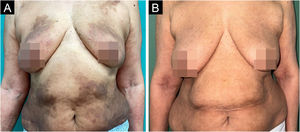 (A) Apresentação clínica basal antes do início do traloquinumabe. Placas eritemato‐acastanhadas em paciente fototipo IV, distribuídas simetricamente principalmente nos flancos, tórax e parte anterior das coxas. (B) Apresentação clínica após seis meses de traloquinumabe. Atenuação das lesões com diminuição das bordas bem definidas.