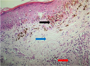 Imagem de anatomopatológico de nevo melanocítico recorrente mostrando um padrão trizonal: componente juncional lentiginoso (seta preta), fibrose dérmica cicatricial (seta azul), ninhos de células névicas (seta vermelha) (Hematoxilina & eosina, 200×).