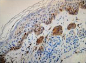 Imagem de análise imuno‐histoquímica de nevo melanocítico recorrente mostrando marcação para o anticorpo Ki‐67. (Imunomarcação com Ki‐67 200×).