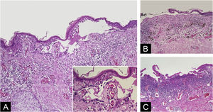 Bolha com melanócitos presentes no fundo da fenda, por vezes revestindo a derme (A – Hematoxilina & eosina, 10×; inserção: detalhe dos melanócitos revestindo a derme – Hematoxilina & eosina, 40×). Bolha subepidérmica rompida sem melanócitos na base, acima de alterações dérmicas regressivas (B – Hematoxilina & eosina, 10×); material basofílico necrótico cobrindo a derme papilar juntamente com infiltrado inflamatório justaposto. Alguns melanócitos discoesos podem ser vistos na borda lateral do tecido necrótico (C – Hematoxilina & eosina, 10×).