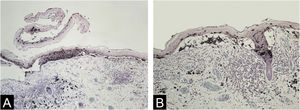 Melanócitos ocupando quase toda a espessura epidérmica na borda lateral de uma bolha rompida, desprovida de melanócitos, visíveis apenas em seu teto (à esquerda), e melanócitos revestindo o fundo de uma fenda estreita (à direita) (A – imunomarcação para Melan‐A, contracoloração com Giemsa, 10×). Melanócitos flutuando no espaço da fenda e entre os queratinócitos no teto. Observe o descolamento epitélio‐estroma nos infundíbulos foliculares (B – imunomarcação para Melan‐A, contracoloração com Giemsa, 10×).