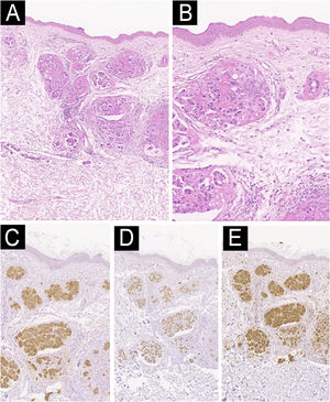 (A) Coloração com hematoxilina & eosina revela extensa infiltração maligna da derme e do tecido subcutâneo por células epiteliais atípicas dispostas em estruturas glandulares irregulares, algumas das quais demonstram permeação intravascular. (B) Em maior aumento (400×), as células tumorais exibem pleomorfismo acentuado, nucléolos proeminentes e aumento da atividade mitótica. (C–E) A imuno-histoquímica demonstra forte e difusa positividade para citoqueratina 7 (CK7), fator de transcrição tireoidiano 1 (TTF‐1) e napsina A, corroborando o diagnóstico de adenocarcinoma metastático de origem pulmonar.
