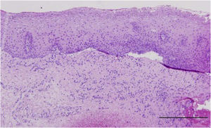 Características histopatológicas representativas do PMM sob microscopia óptica. Separação epitelial da lâmina própria com denudação parcial. A superfície do tecido conjuntivo denudado apresenta‐se lisa, acompanhada pela formação de bolhas subepiteliais. A lâmina própria demonstra infiltração de linfócitos, plasmócitos e eosinófilos.