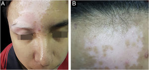 (A) Paciente do sexo masculino, de 14 anos, diagnosticado com vitiligo, apresentando mancha acrômica envolvendo a região da glabela e estendendo‐se até a pálpebra superior direita, associada à poliose dos cílios superiores direitos. (B) Mesmo paciente após 12 sessões quinzenais de fototerapia com luz Excimer de 308nm, com boa resposta e sinais de repigmentação.