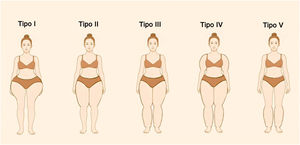 Diagrama gráfico representando os cinco subtipos de lipedema de acordo com o padrão de distribuição.