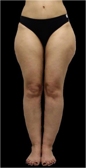 Lipedema tipo I. Observe a assimetria entre os membros, com maior acúmulo de gordura no membro inferior esquerdo.