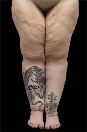 Lipedema tipo III. A paciente fez tatuagens sobre as áreas afetadas na tentativa de disfarçar a condição.
