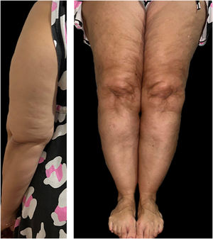 Lipedema tipo IV.