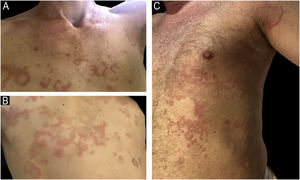 (A–B) Caso 4: Placas anulares com cicatrização central e bordas eritematosas no tronco. (C) Caso 2: Pápulas urticariformes e placas eritematosas no tronco e extremidades.