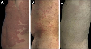 Caso 2: Pré e pós‐tratamento. (A) Linha de base (ciclosporina 3,5mg/kg/dia). (B) Nove dias de tratamento. (C) Remissão completa após quatro semanas de tratamento.