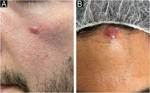 Espectro clínico do distúrbio linfoproliferativo cutâneo primário de células T CD4+pequenas/médias. Diferentes apresentações clínicas desta doença.