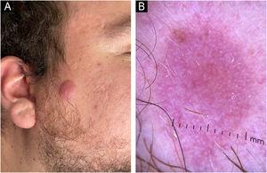Achados clínicos (A) e dermatoscópicos (B) do caso 3 com diagnóstico de distúrbio linfoproliferativo cutâneo primário de células T CD4+pequenas/médias.