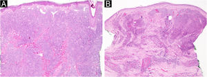 Histopatologia do distúrbio linfoproliferativo cutâneo primário de células T CD4+pequenas/médias. As células linfoides são de pequeno a médio porte na coloração de Hematoxilina & eosina.